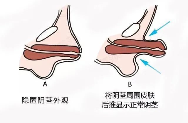 家长注意男孩鸡鸡短小不要错过最佳治疗时机