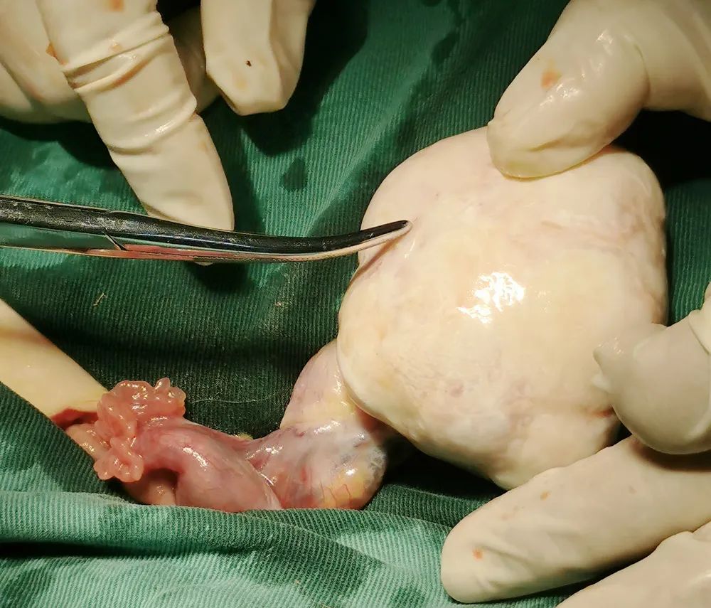 一天2位卵巢囊肿患者医生绝经期女性体检别忽视