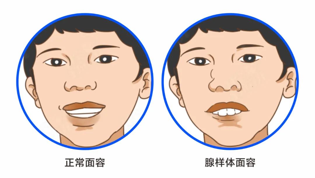 【耳鼻喉科福利】儿童"腺样体肥大"免费检测-耳鼻喉科-株洲天元医院